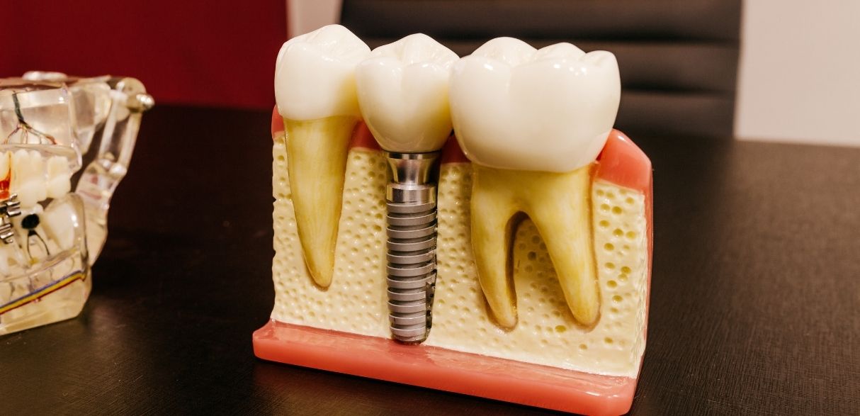 can you eat anything with dental implants