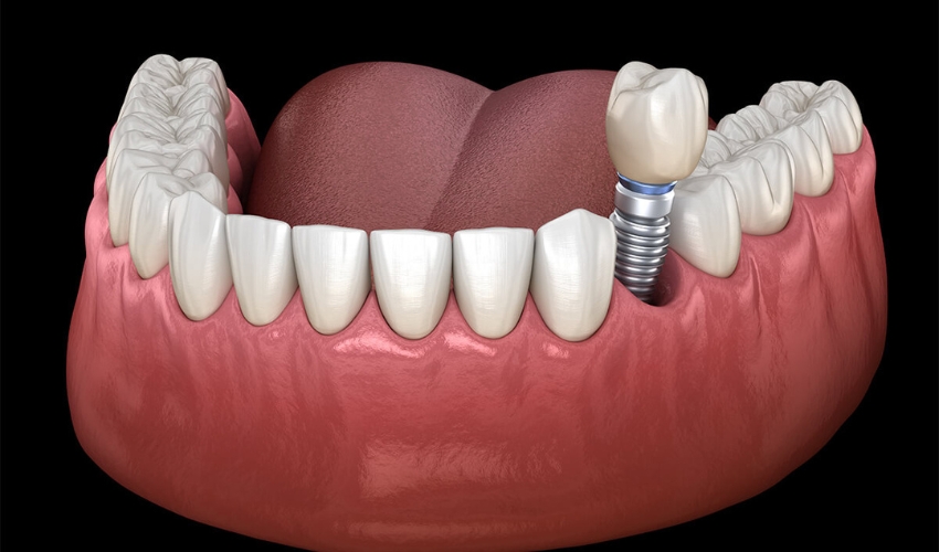 Can Dental Implants Get Cavities